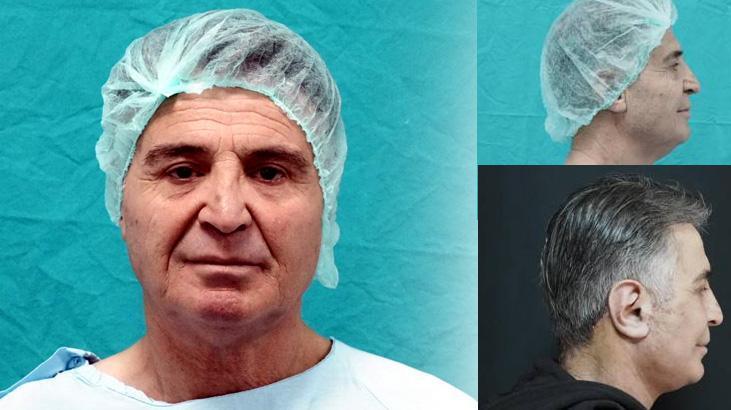 Devlet Hastanesinde Çığır Açan Estetik Uygulama: 15 Yıl Gençleşme