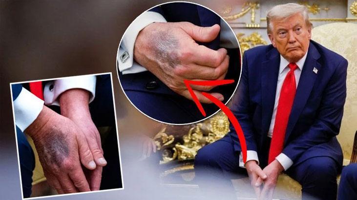 Trump Elindeki Morlukların Nedenini Açıkladı: Aspirin ve Sağlık Söylentileri