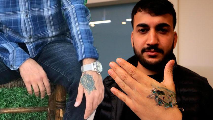 Dövme Sildirme İşlemi Felakete Dönüştü: Güzellik Merkezinin Hatası Genç Adama İkinci Derece Yanık Bıraktı