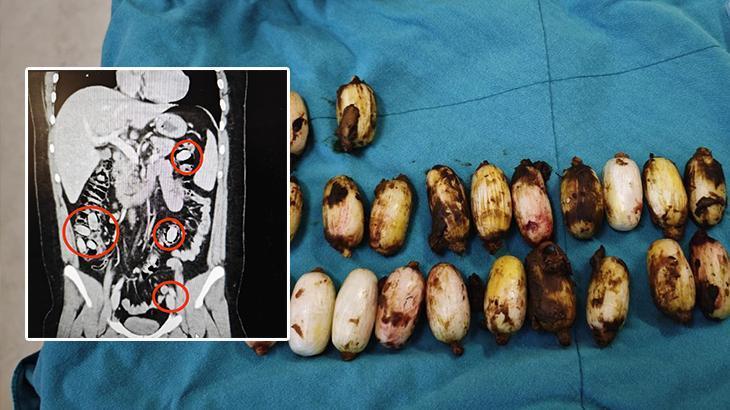 Midesinde 44 Kapsül Uyuşturucu Saklayan Şüpheli Tutuklandı