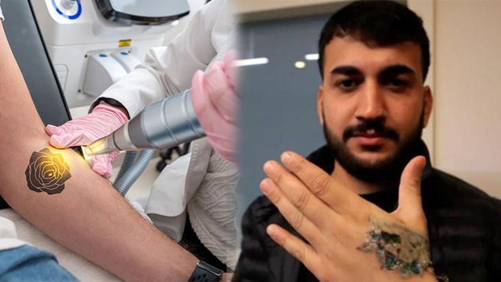 Dövme Sildirme Kabusu: Lazer Uygulaması Cilt Nakli Gerektiren Ciddi Hasara Yol Açtı
